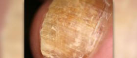 Information on Curanail