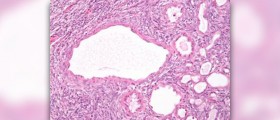 Information on cystic fibrosis symptoms