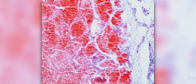 Information on hemorrhagic stroke