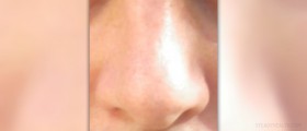 Information on nosebleeds