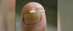 Ingrown toenail relief