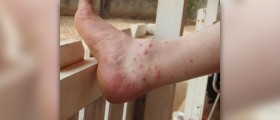 Insect bite rashes