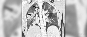 Interstitial lung disease