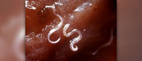 Intestinal parasites in humans