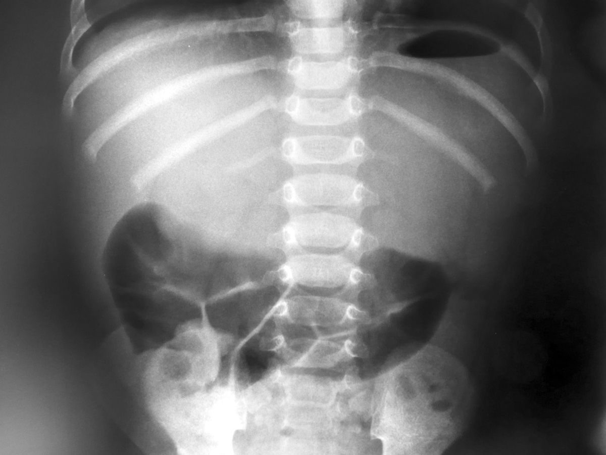 causes-of-intestinal-obstruction