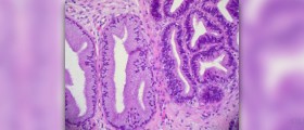 Invasive cancer of the cervix
