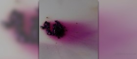 Iodine deficiency symptoms