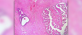 Is endometriosis dangerous