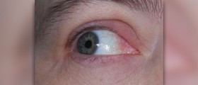 Is eye stye contagious
