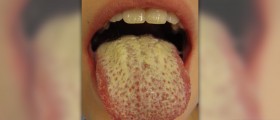 Is oral thrush contagious