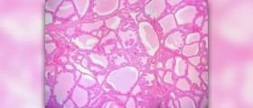 Is there a cure for Graves disease