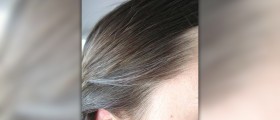 Is there a cure for gray hair?