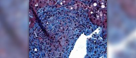 Is there a cure for hepatitis?