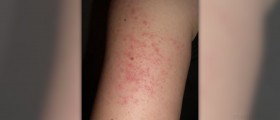 Is there a cure for keratosis pilaris