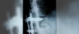 Is there a cure for Kyphosis
