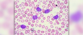 Is there a cure for leukemia
