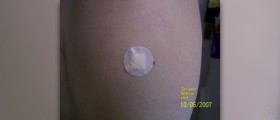 Is there a cure for tetanus?