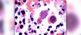 Is there a higher risk to your pregnancy because of toxoplasmosis?