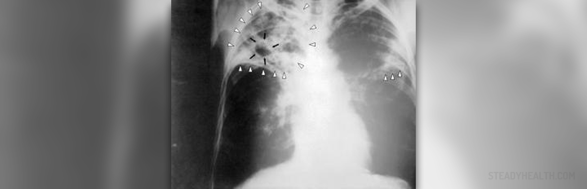 is-tuberculosis-contagious-respiratory-tract-disorders-and-diseases