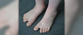 Itchy blisters on feet