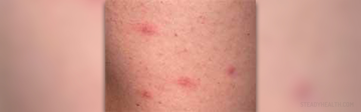 Itchy Rash On Chest General Center