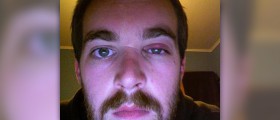 Itchy swollen eyelids