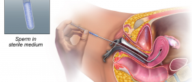 Trying to get pregnant with IUI