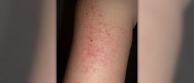 Keratosis pilaris home remedy