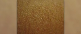 Keratosis pilaris on face