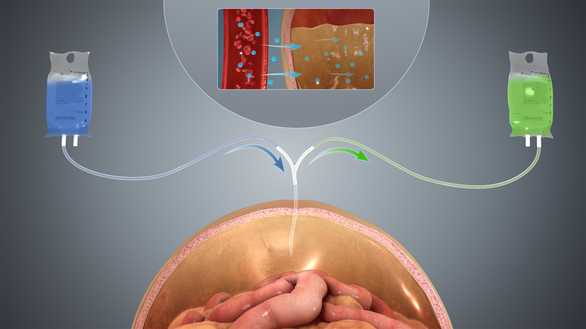 Kidney issue: Peritoneal dialysis procedure | Urinary Tract Issues