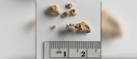 Kidney stones and pregnancy