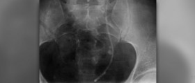 Kidney stones alternative treatments