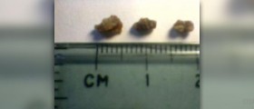 Kidney stones symptoms in women