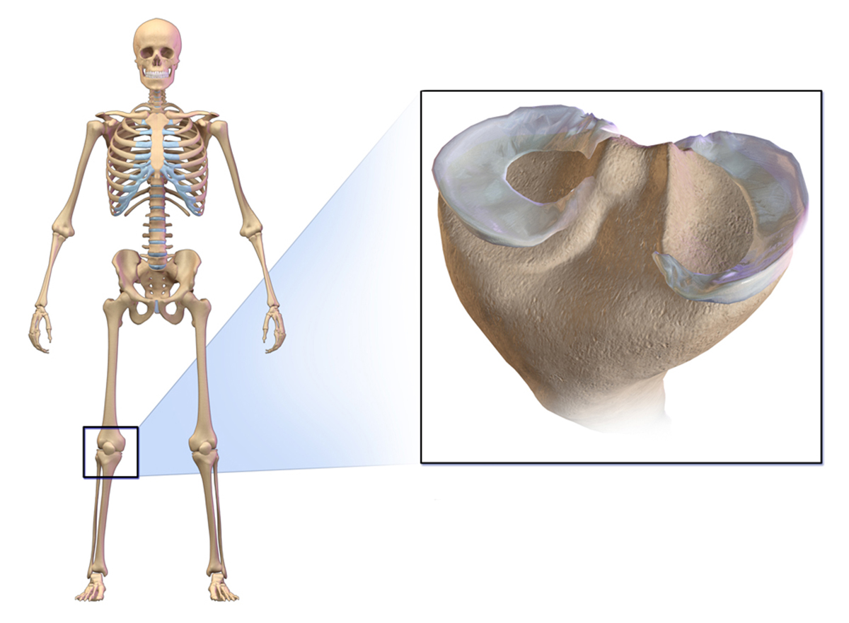 broken patella recovery time