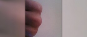 Knuckle pain and swelling