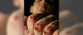 Knuckle pain relief