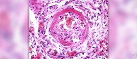 Labile hypertension facts