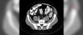 Laparoscopic appendectomy review