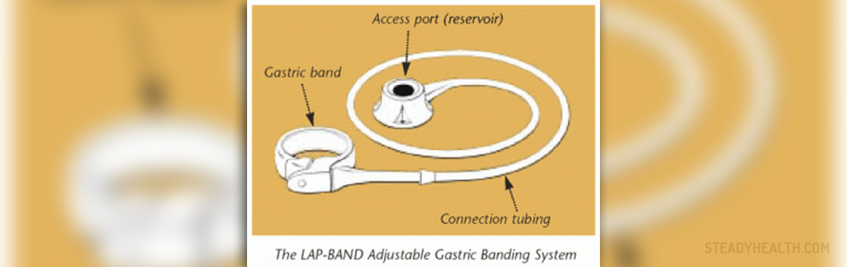 How much could i expect to pay for lap band surgery