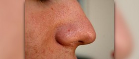 Large nose pores