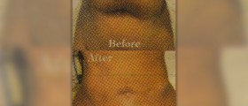 Large volume liposuction procedure