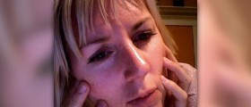 Laser surgery treatment for rosacea