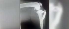 Lateral collateral ligament