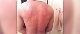 Learn why can stress cause hives and how you can clear them naturally