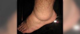 Leg swelling causes