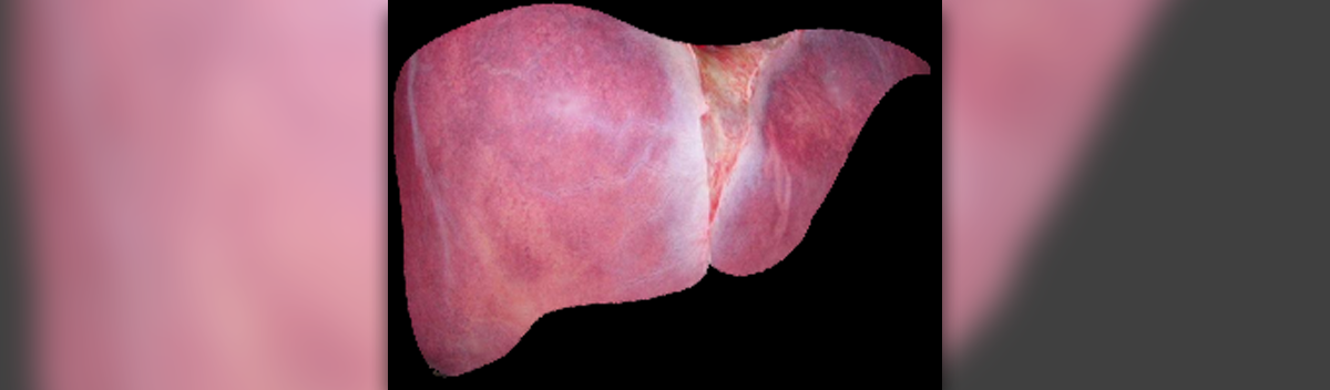 Lesions On Liver General Center SteadyHealth