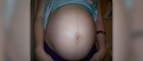 Linea negra - a dark vertical line on your tummy