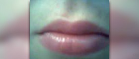 Lip augmentation for more beautiful lips