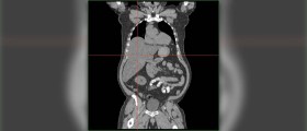 Enlarged liver and spleen causes