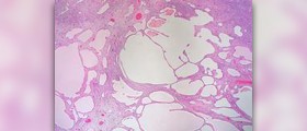 Liver hemangioma in adults